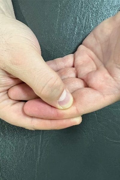 exercice kine retrait orthese massage circulaire doigts chirurgiens orthopedistes specialistes de la main et du poignet clinique de l epaule et de la main 92