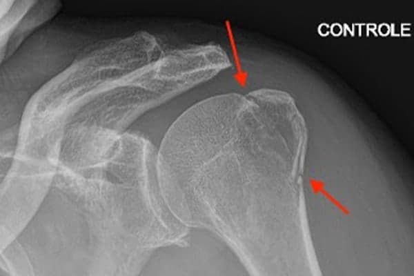 radio apres operation fracture de la clavicule plaque vissee urgences orthopediques 92 paris ouest clinique de l epaule et de la main neuilly sur seine