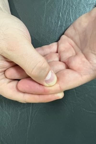 massage main sensibilite kine chirurgiens orthopedistes specialistes de la main et du poignet clinique de l epaule et de la main 92