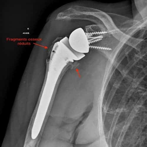 radio apres operation fracture de la clavicule plaque vissee urgences orthopediques 92 paris ouest clinique de l epaule et de la main neuilly sur seine
