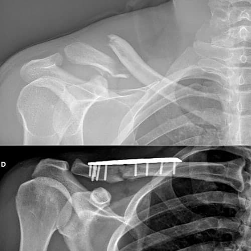 radio controle post operatoire operation fracture de la clavicule urgences orthopediques 92 paris ouest clinique de l epaule et de la main neuilly sur seine