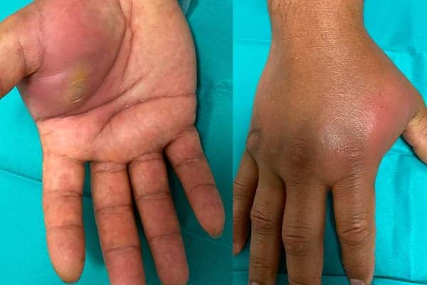 abces main symptomes causes chirurgiens orthopedistes membre superieur paris neuilly sur seine clinique de l epaule et de la main paris ouest 92
