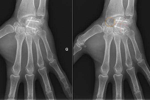 arthrodese poignet 2 arthrose slac snac poignet chirurgiens orthopedistes membre superieur paris neuilly sur seine clinique de l epaule et de la main paris ouest 92