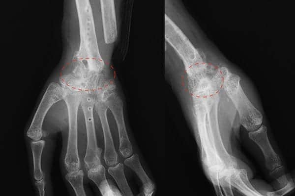 arthrodese poignet ablation plaque arthrose slac snac poignet chirurgiens orthopedistes membre superieur paris neuilly sur seine clinique de l epaule et de la main paris ouest 92
