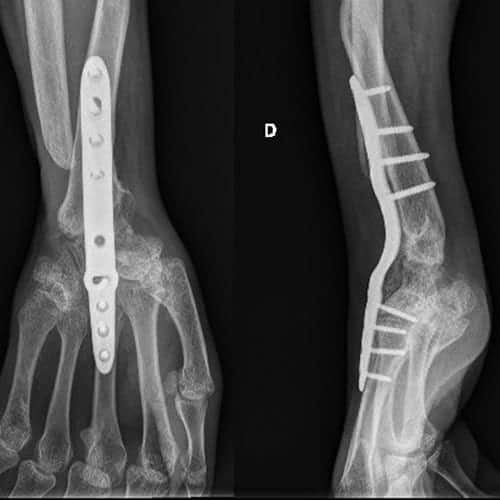 arthrodese poignet arthrose slac snac poignet chirurgiens orthopedistes membre superieur paris neuilly sur seine clinique de l epaule et de la main paris ouest 92