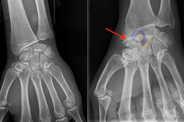 arthrose slac snac poignet chirurgiens orthopedistes membre superieur paris neuilly sur seine clinique de l epaule et de la main paris ouest et 92