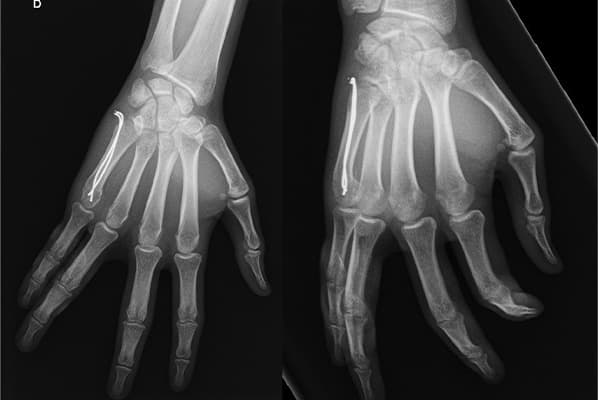 chirurgie fracture de la main chirurgiens orthopedistes membre superieur paris neuilly sur seine clinique de l epaule et de la main paris ouest 92