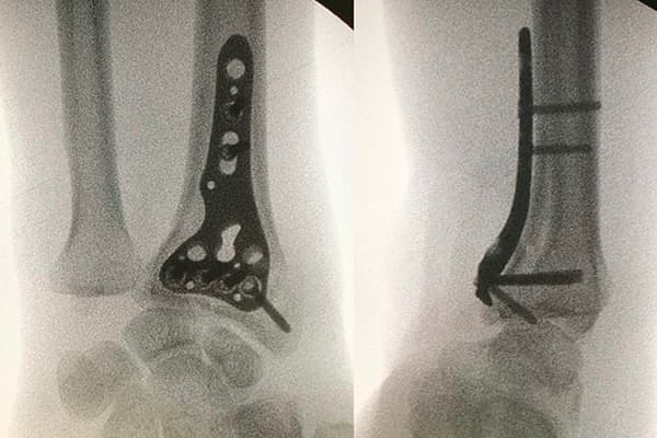 chirurgie fractures poignet chirurgiens orthopedistes membre superieur paris neuilly sur seine clinique de l epaule et de la main paris ouest 92