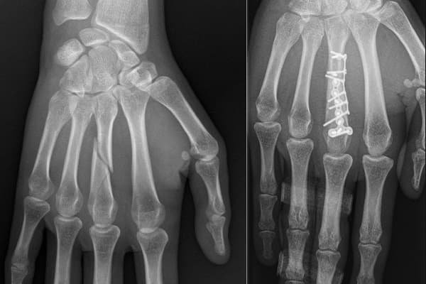 fracture de la main radio chirurgiens orthopedistes membre superieur paris neuilly sur seine clinique de l epaule et de la main paris ouest 92