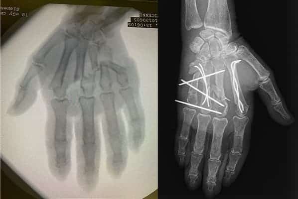 fractures main operation chirurgiens orthopedistes membre superieur paris neuilly sur seine clinique de l epaule et de la main paris ouest 92