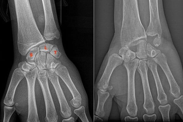 poignet normal resection premiere rangee arthrose slac snac poignet chirurgiens orthopedistes membre superieur paris neuilly sur seine clinique de l epaule et de la main paris ouest 92