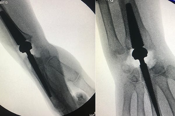 prothese totale poignet arthrose slac snac poignet chirurgiens orthopedistes membre superieur paris neuilly sur seine clinique de l epaule et de la main paris ouest 92