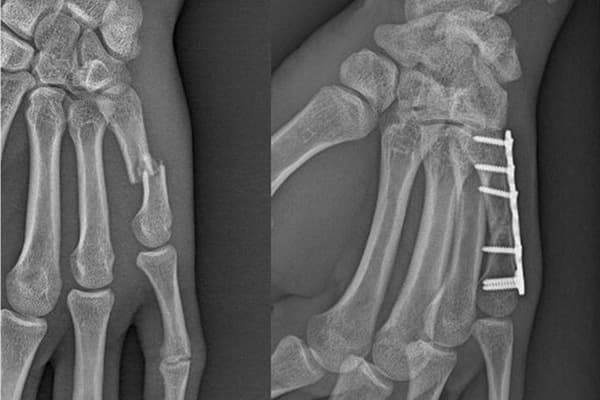 radio fracture de la main chirurgiens orthopedistes membre superieur paris neuilly sur seine clinique de l epaule et de la main paris ouest 92