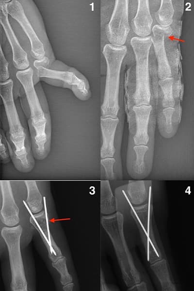 radiographie fracture main photo chirurgiens orthopedistes membre superieur paris neuilly sur seine clinique de l epaule et de la main paris ouest 92