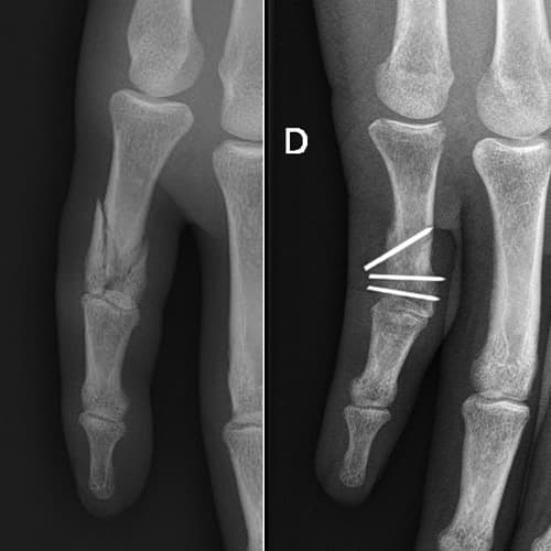 traitement operation fracture main doigts chirurgiens orthopedistes membre superieur paris neuilly sur seine clinique de l epaule et de la main paris ouest 92