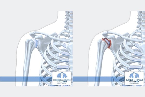 comparaison epaule normale arthrose centre chirurgie orthopediste clinique epaule main paris ouest