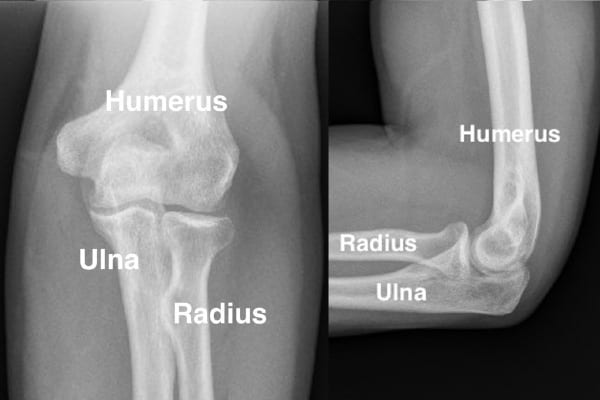 radiographie coude normal luxation du coude chirurgie orthopediste coude clinique coude epaule main paris ouest