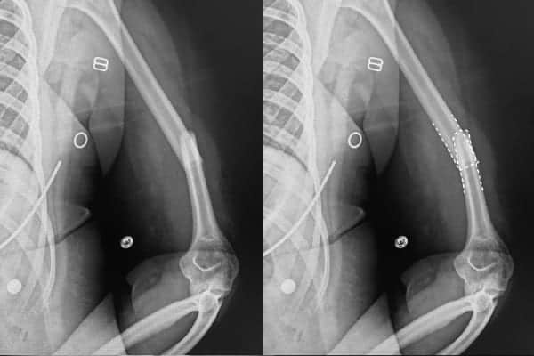 radiographie fracture humerus chirurgie orthopediste epaule clinique coude epaule main paris ouest